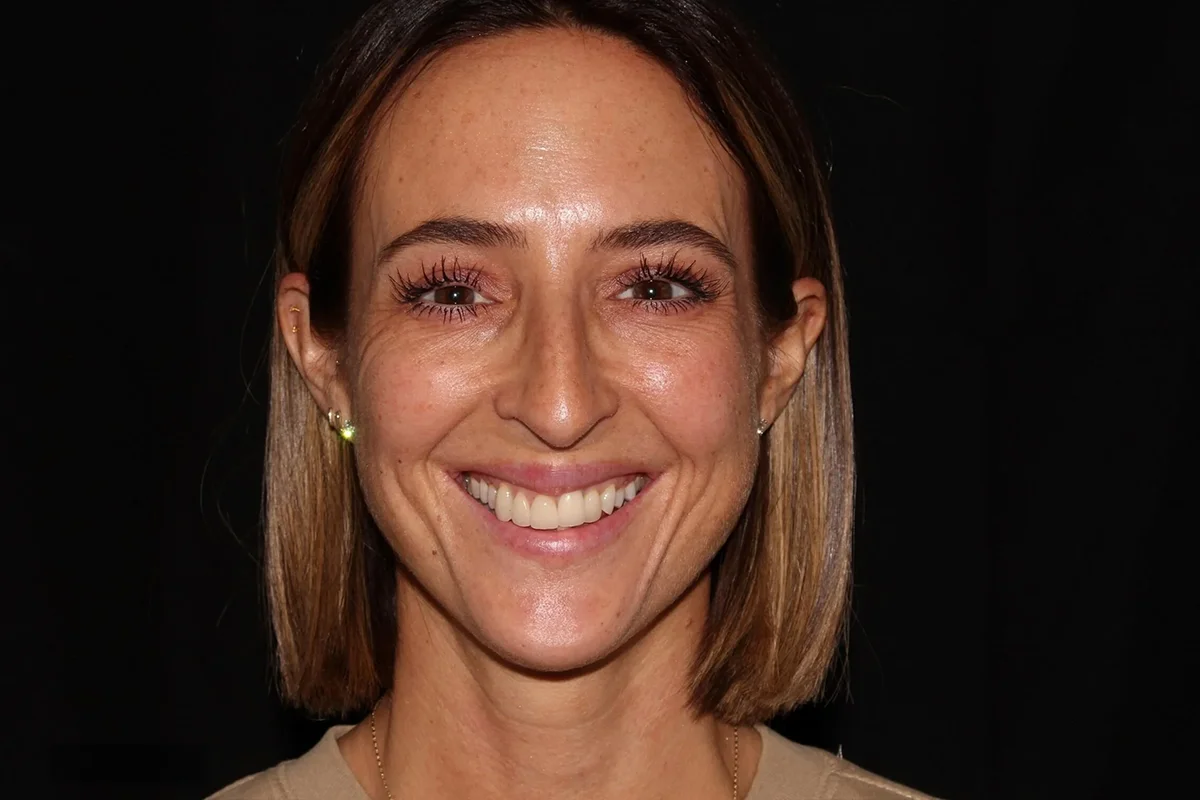 Middle-aged woman before neurotoxin and filler