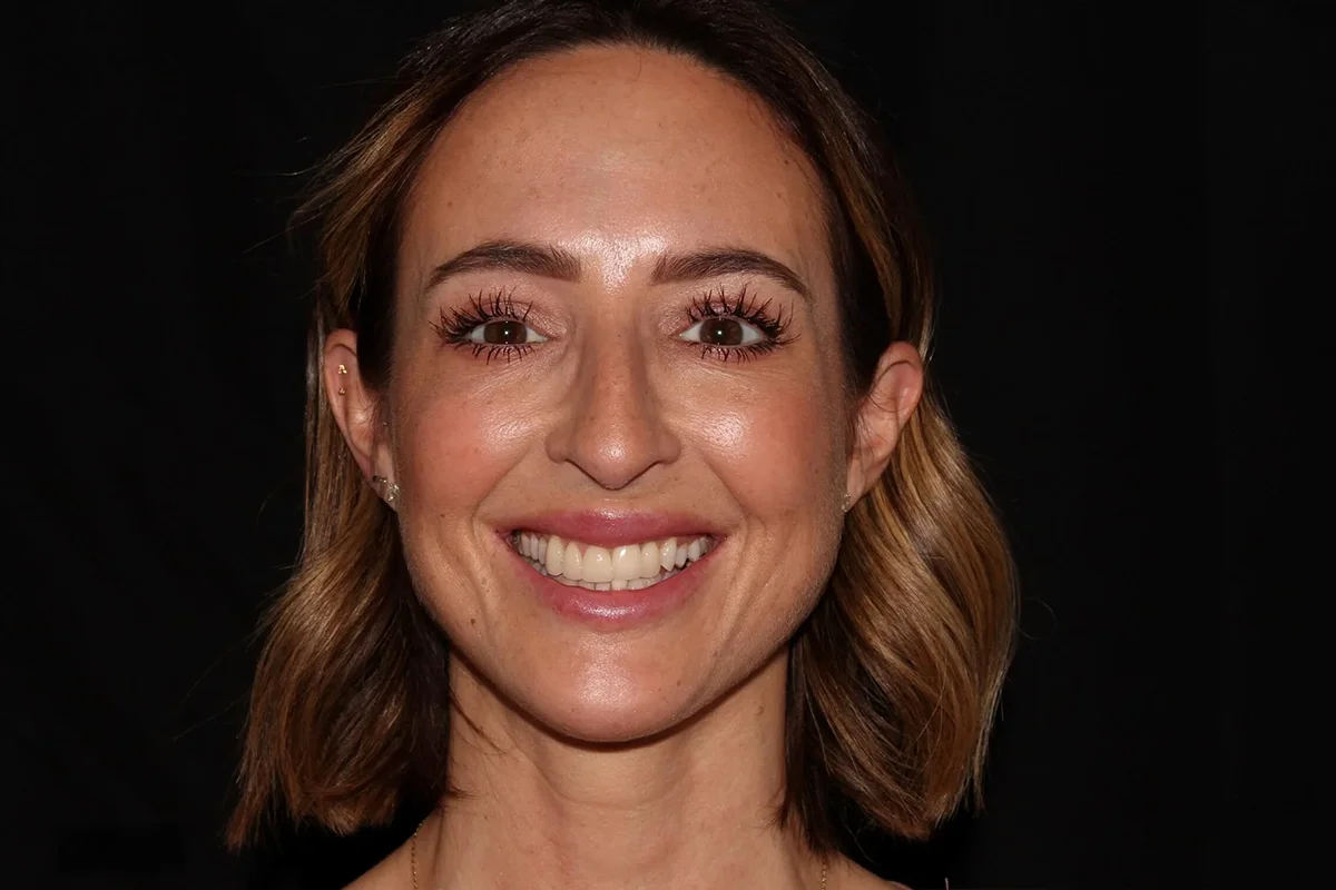 Middle-aged woman after neurotoxin and filler