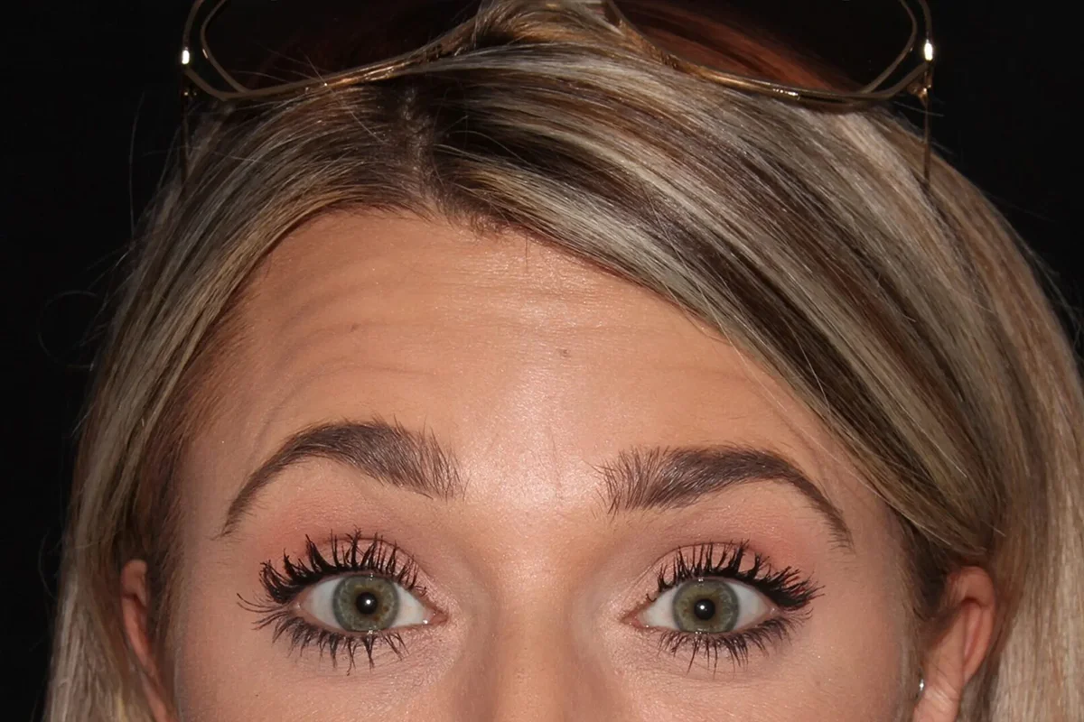 Young woman before Botox