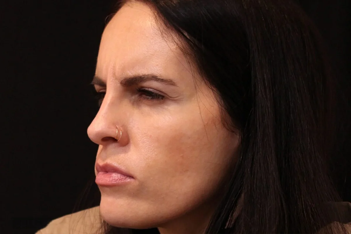 Middle-aged woman before Botox