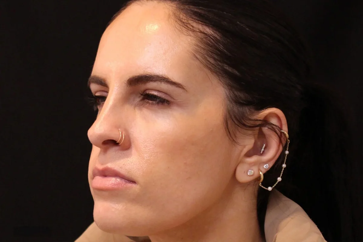 Middle-aged woman after Botox