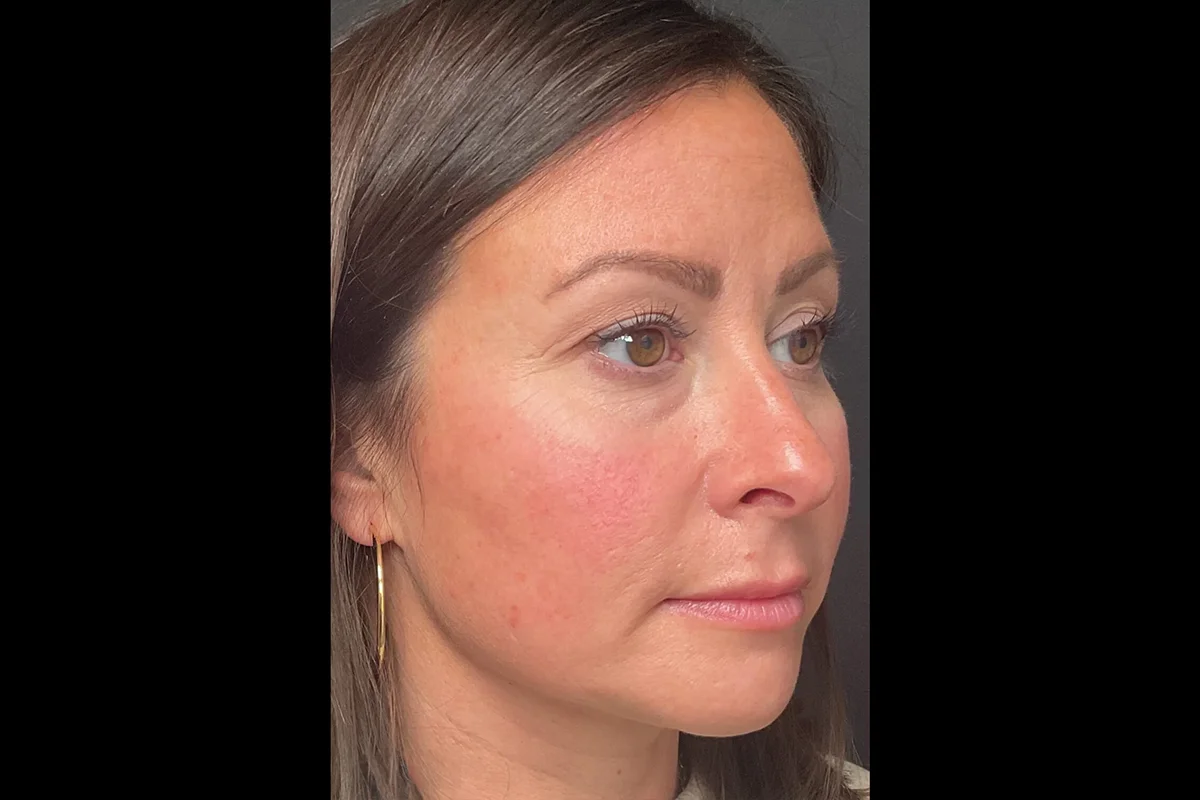 Middle-aged woman before Botox