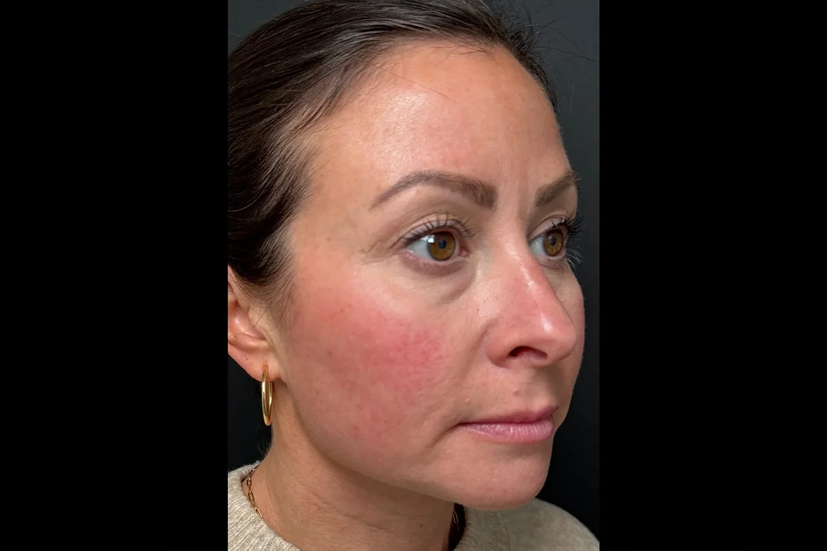 Middle-aged woman after Botox