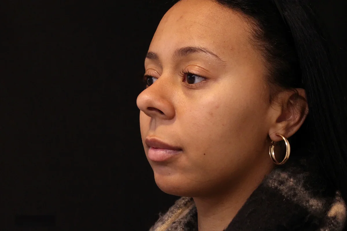 Young woman before lip filler