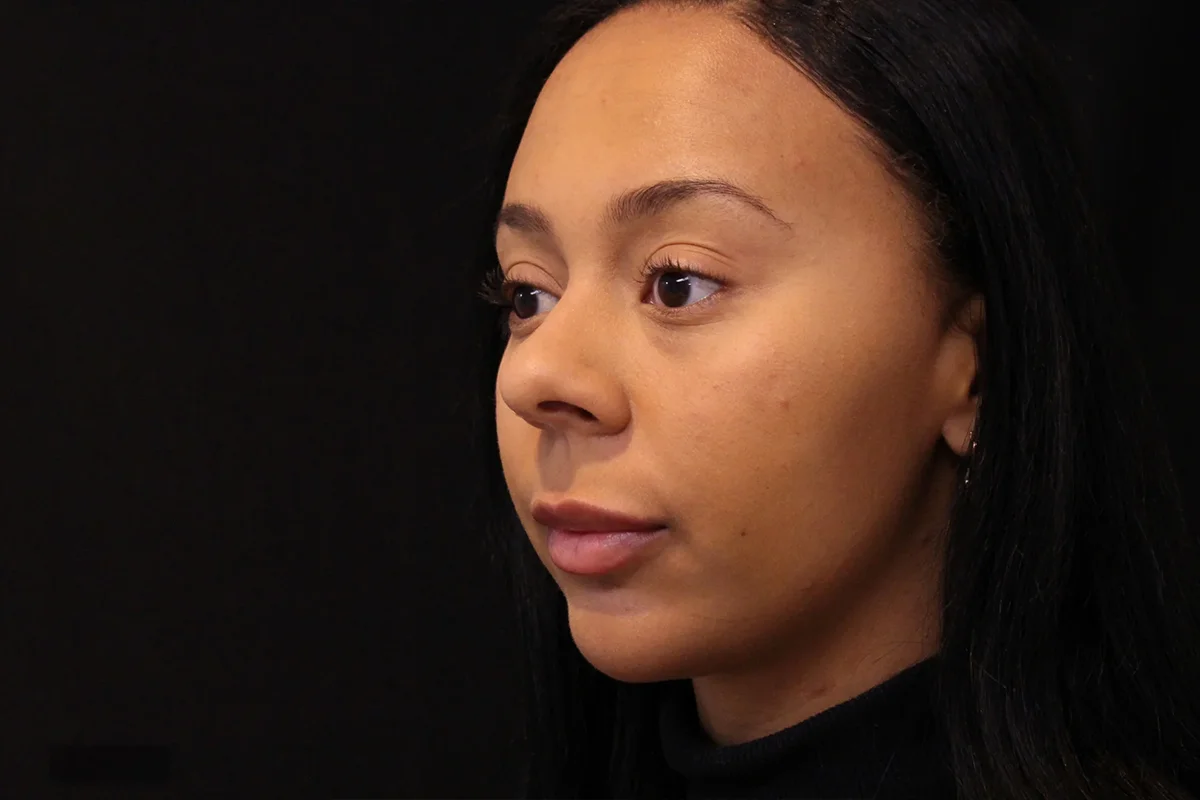 Young woman after lip filler