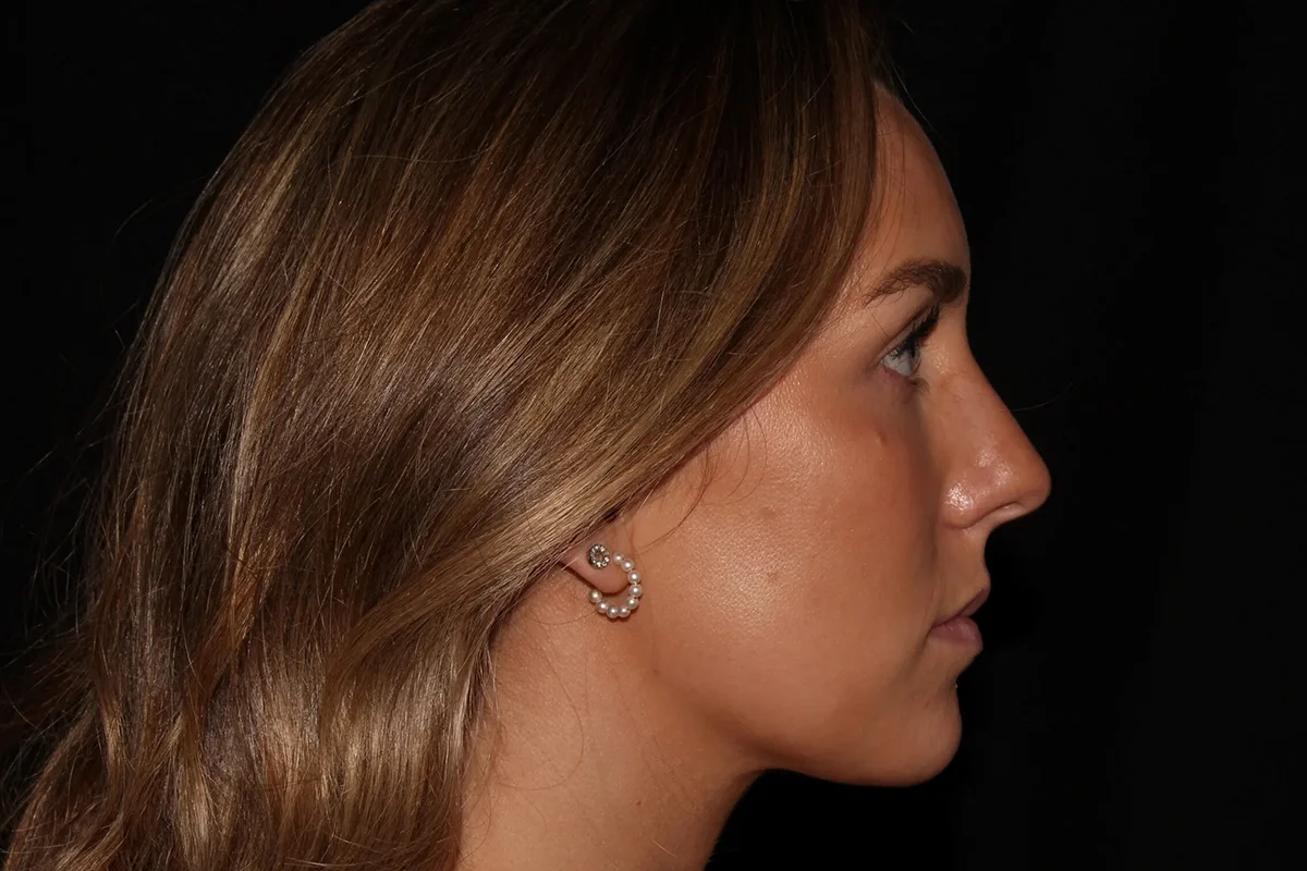 Young woman before lip filler