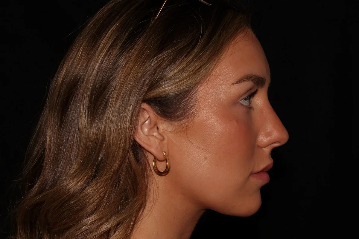 Young woman after lip filler