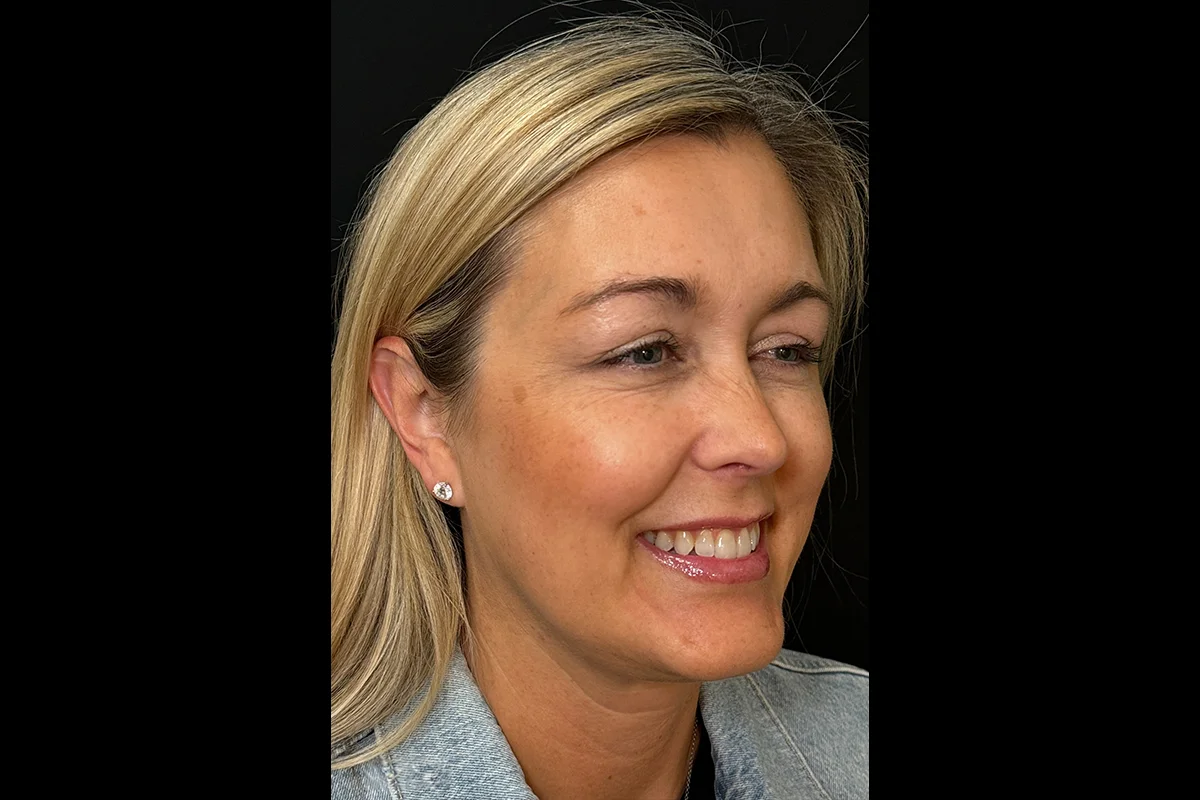 Middle-aged woman after Daxxify