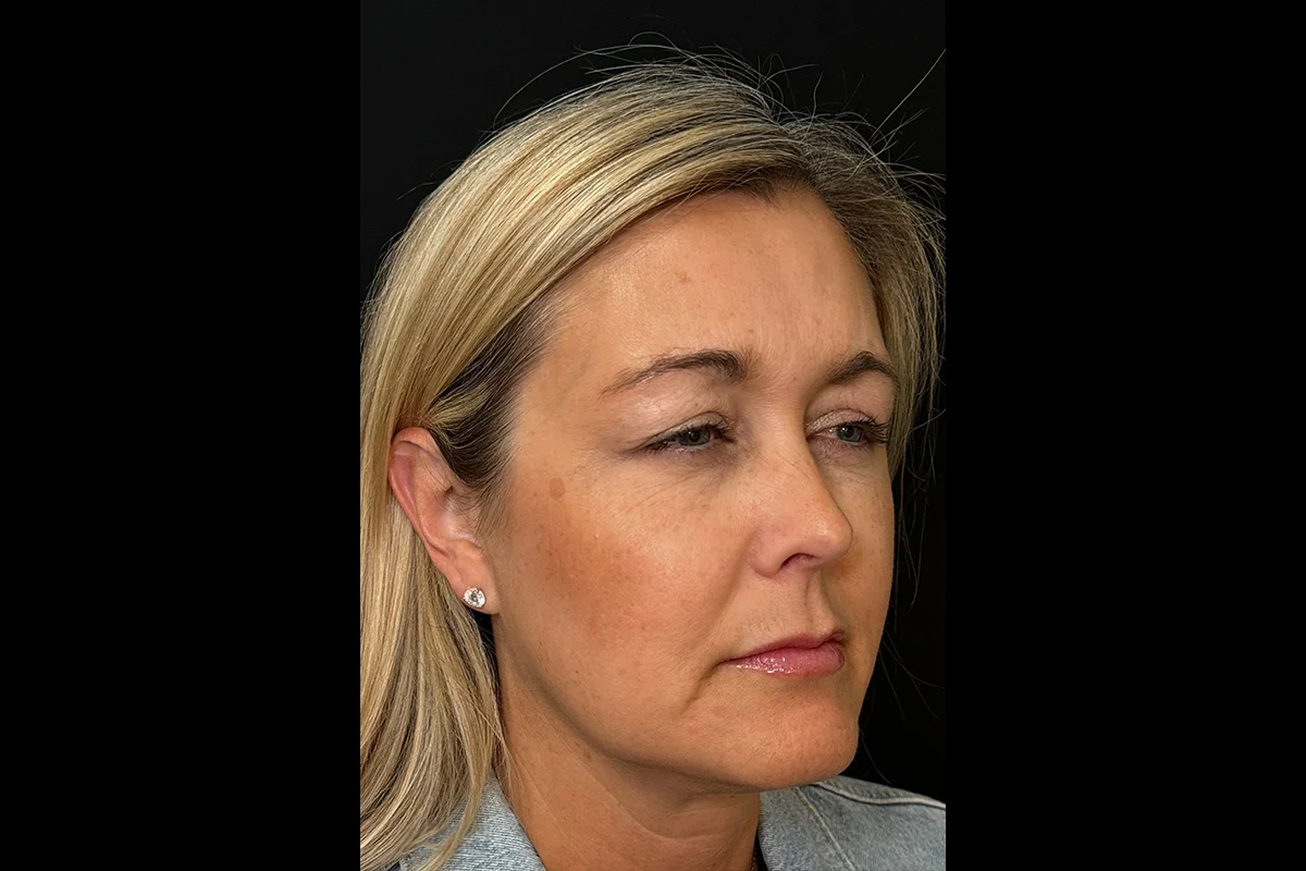 Middle-aged woman after Daxxify