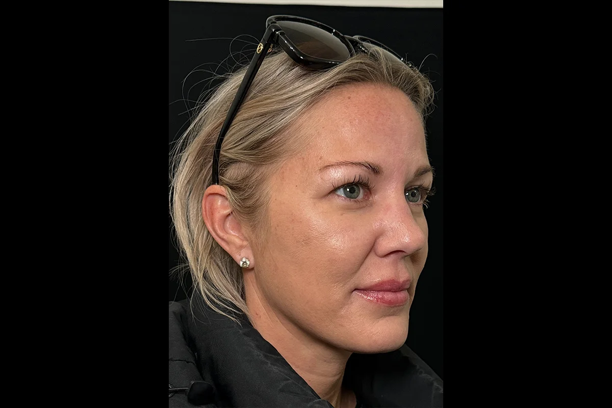 Middle-aged woman before Daxxify