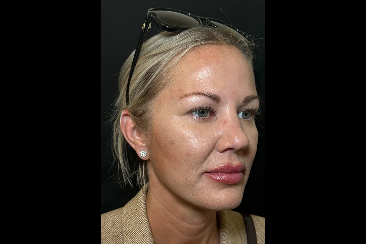 Middle-aged woman after Daxxify