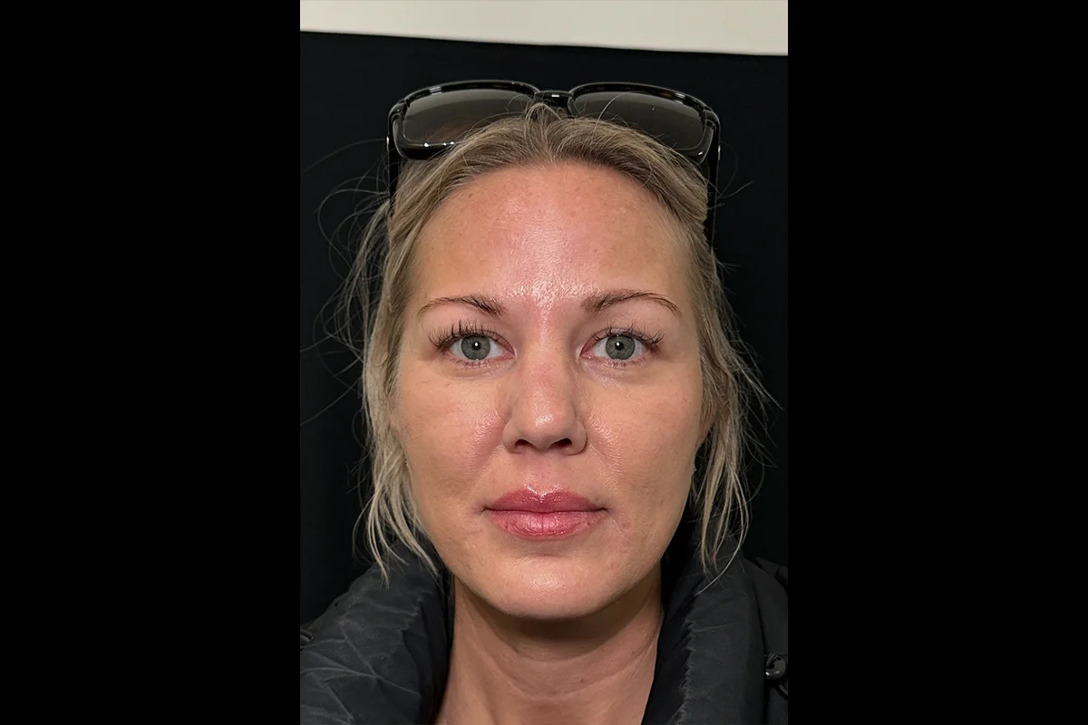 Middle-aged woman before Daxxify