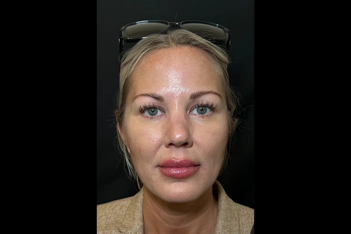 Middle-aged woman after Daxxify