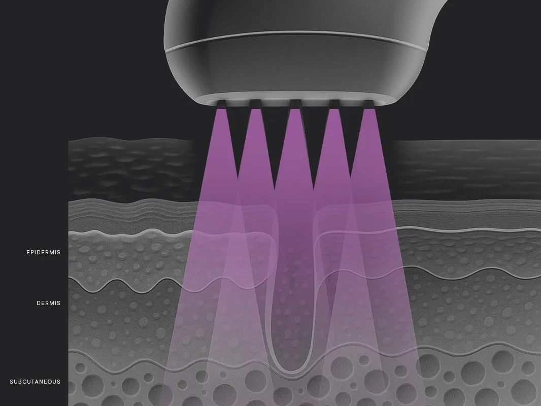 Illustration showing a BBL® HERO™ laser treating the skin, with a labeled diagram of the different layers.