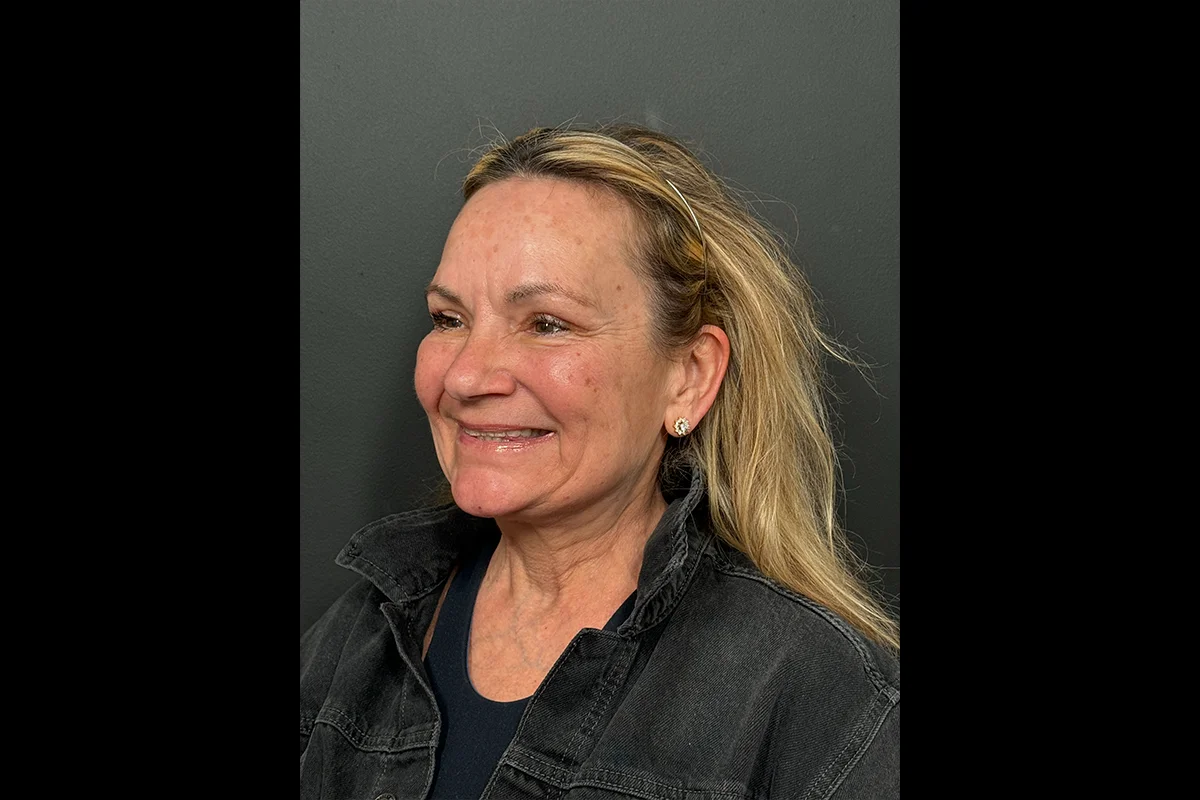 Older woman after facial filler