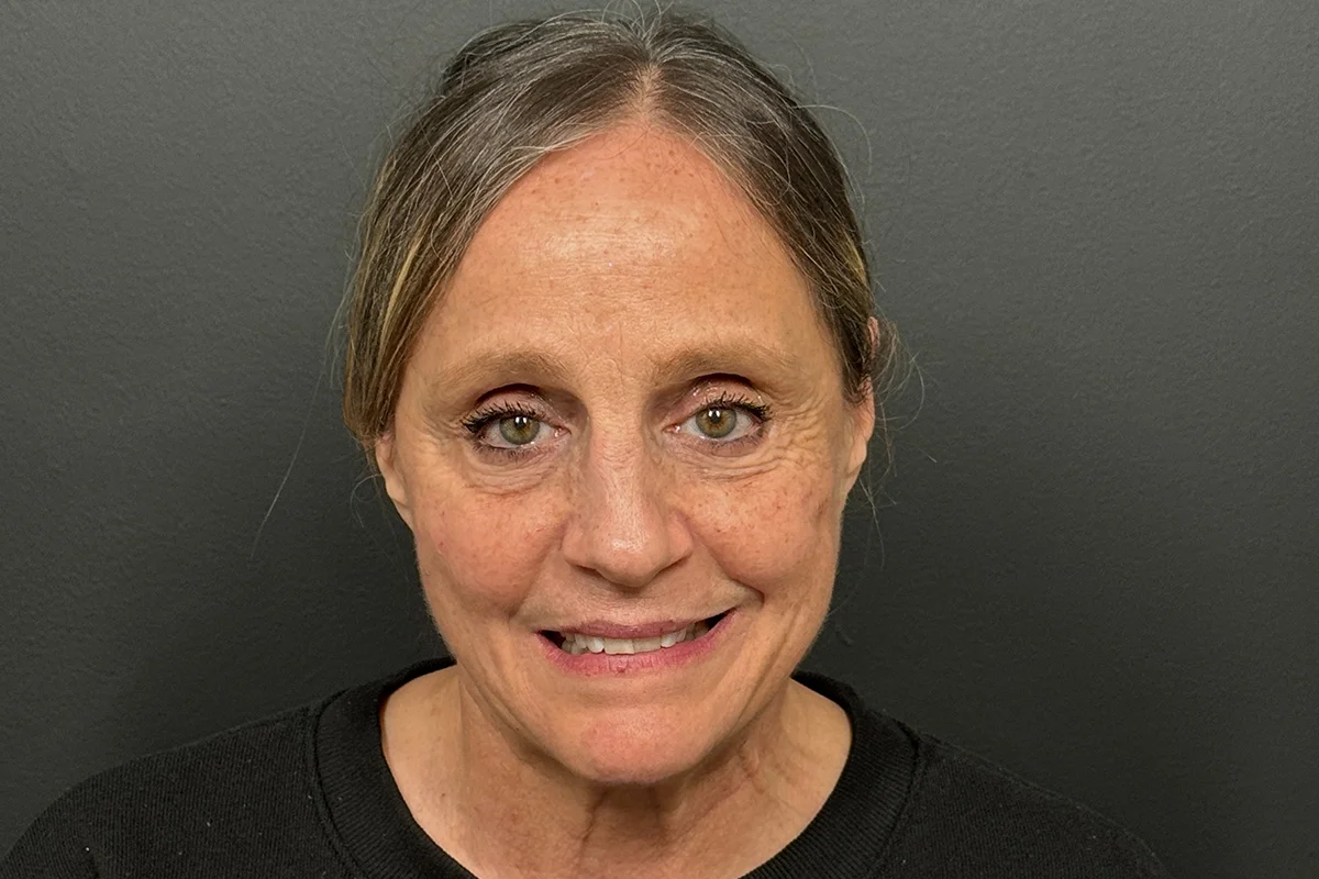 Older woman before facial filler