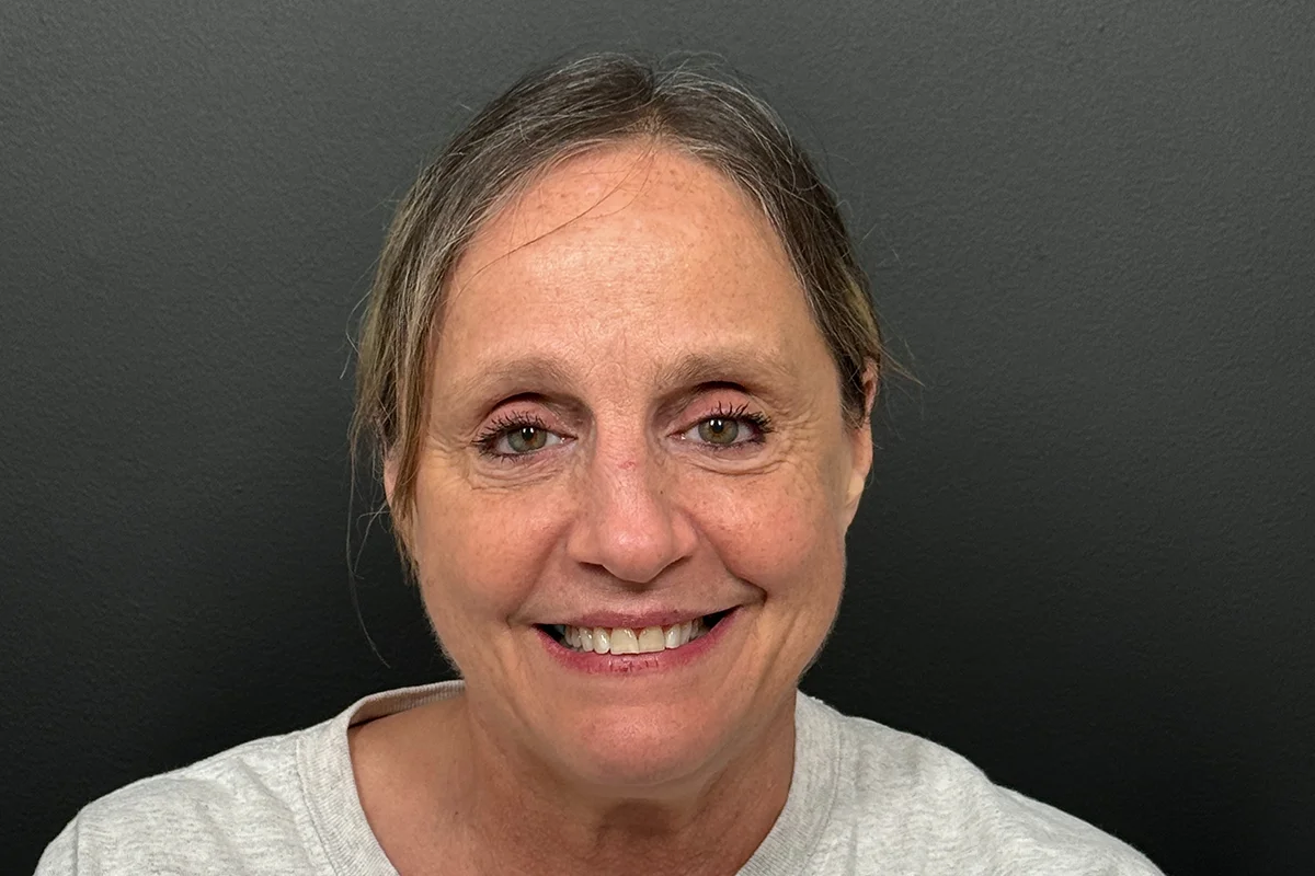 Older woman after facial filler