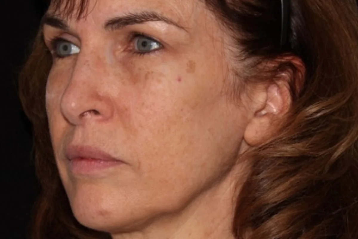 Middle-aged woman before IPL