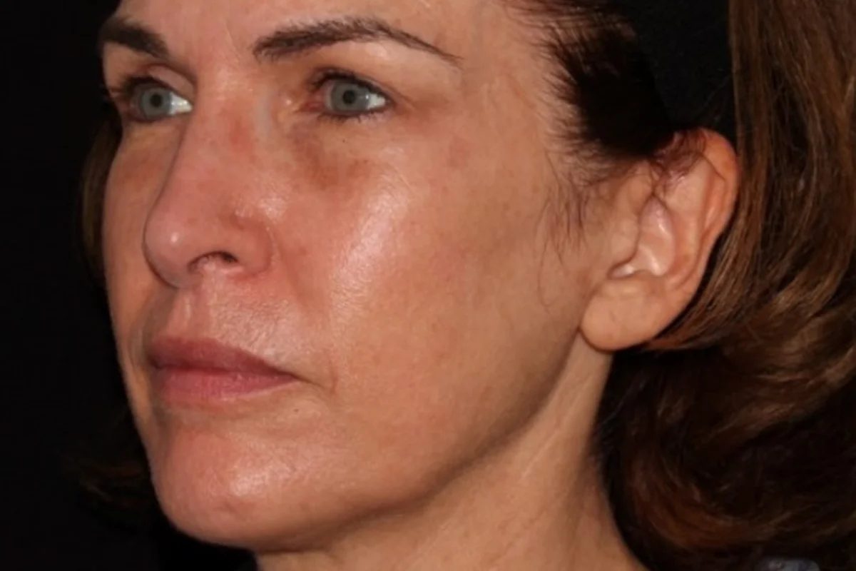 Middle-aged woman after IPL