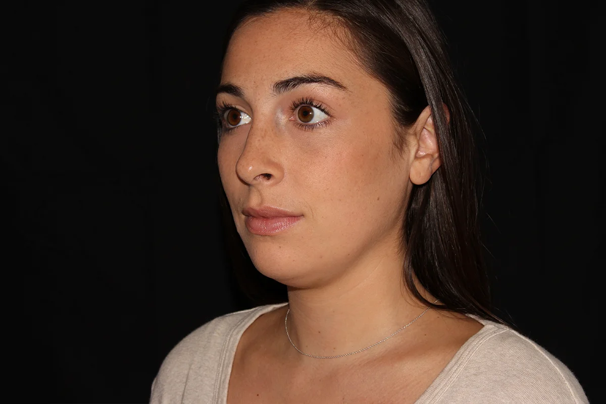 Young woman before Kybella