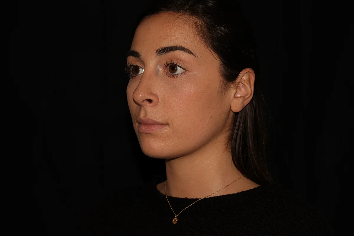 Young woman after Kybella