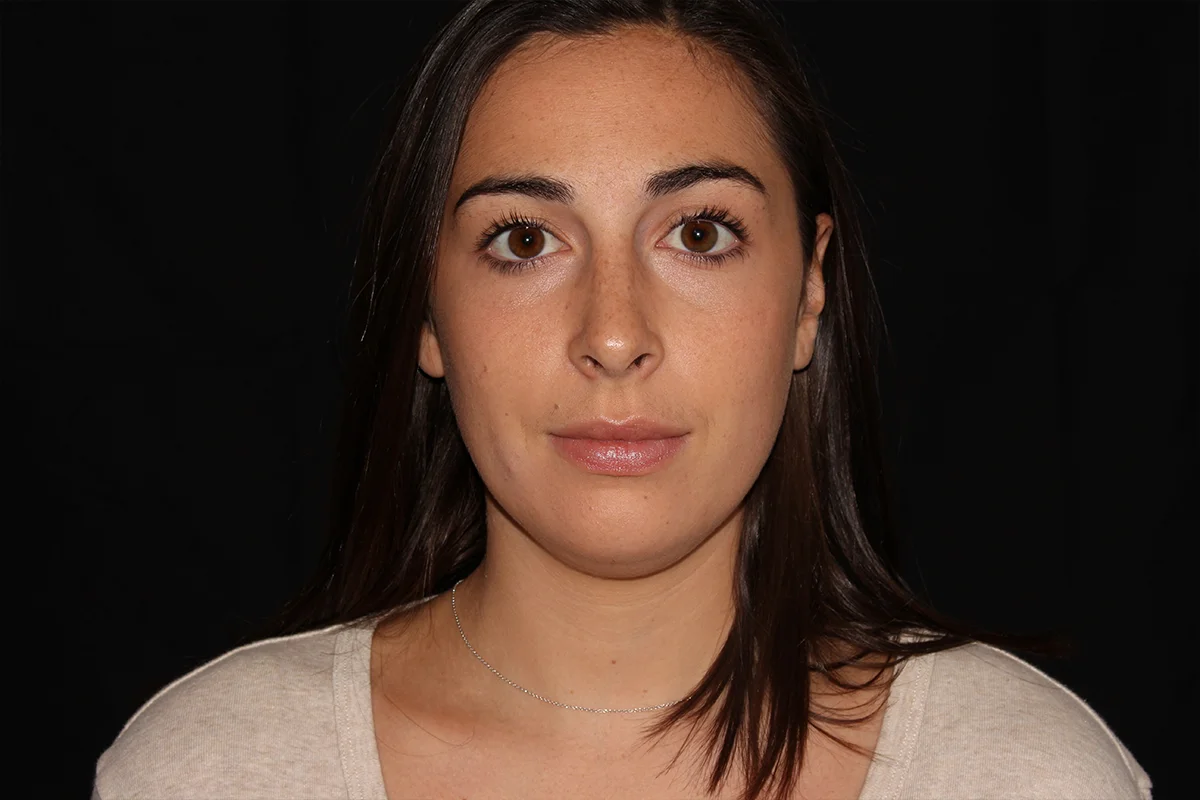 Young woman before Kybella