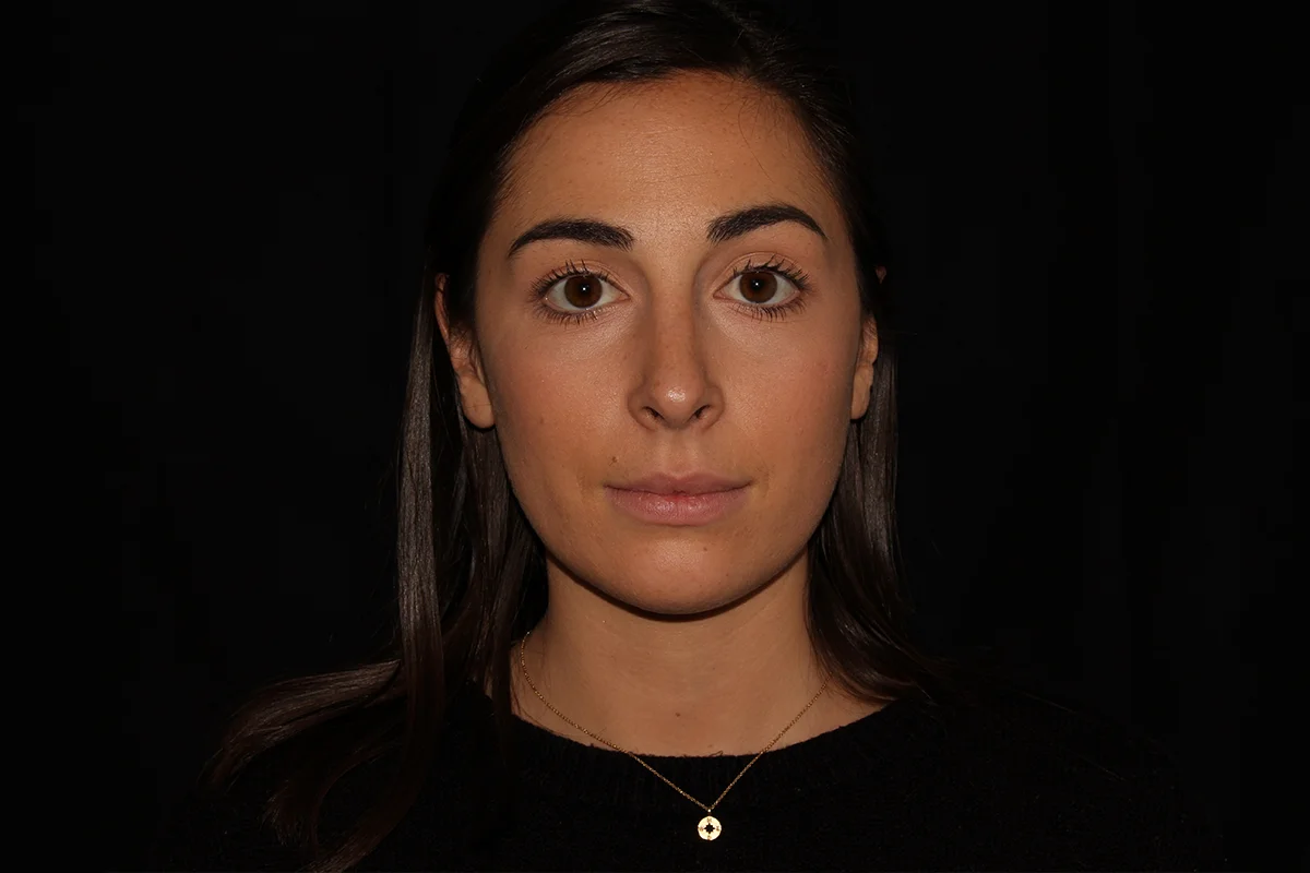 Young woman after Kybella