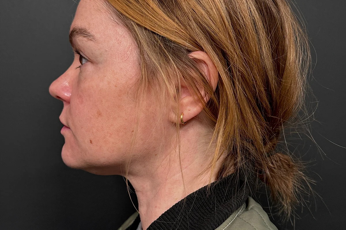 Middle-aged woman before Kybella