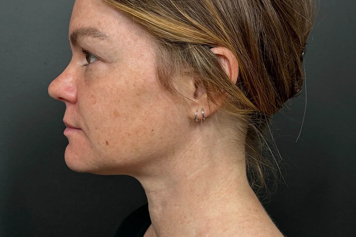 Middle-aged woman after Kybella