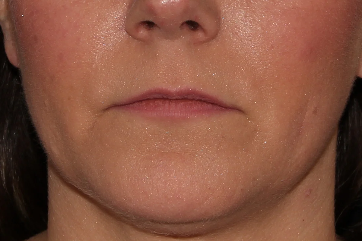 Middle-aged woman before lip filler