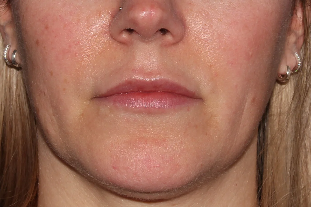 Middle-aged woman after lip filler