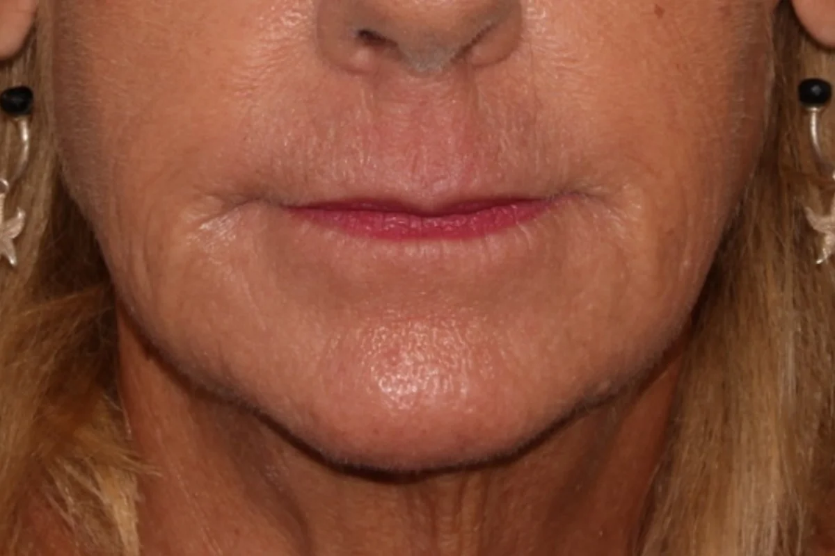 Older woman before lip filler