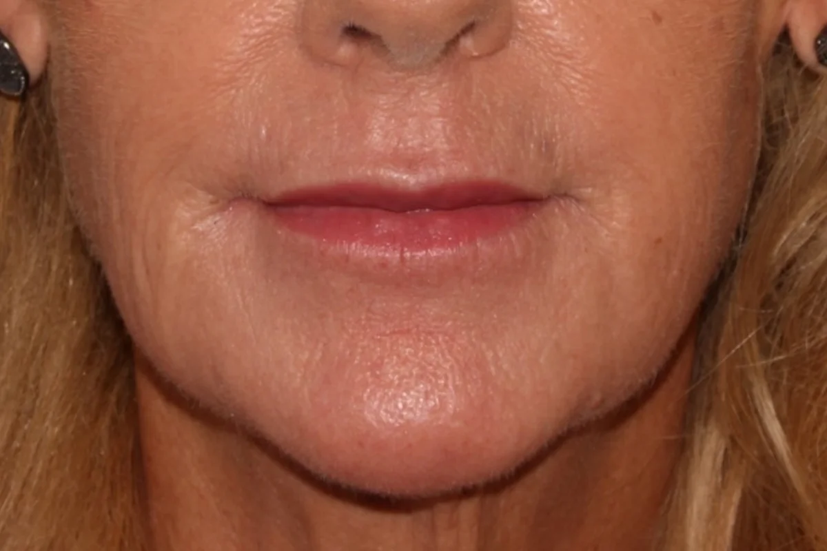 Older woman after lip filler