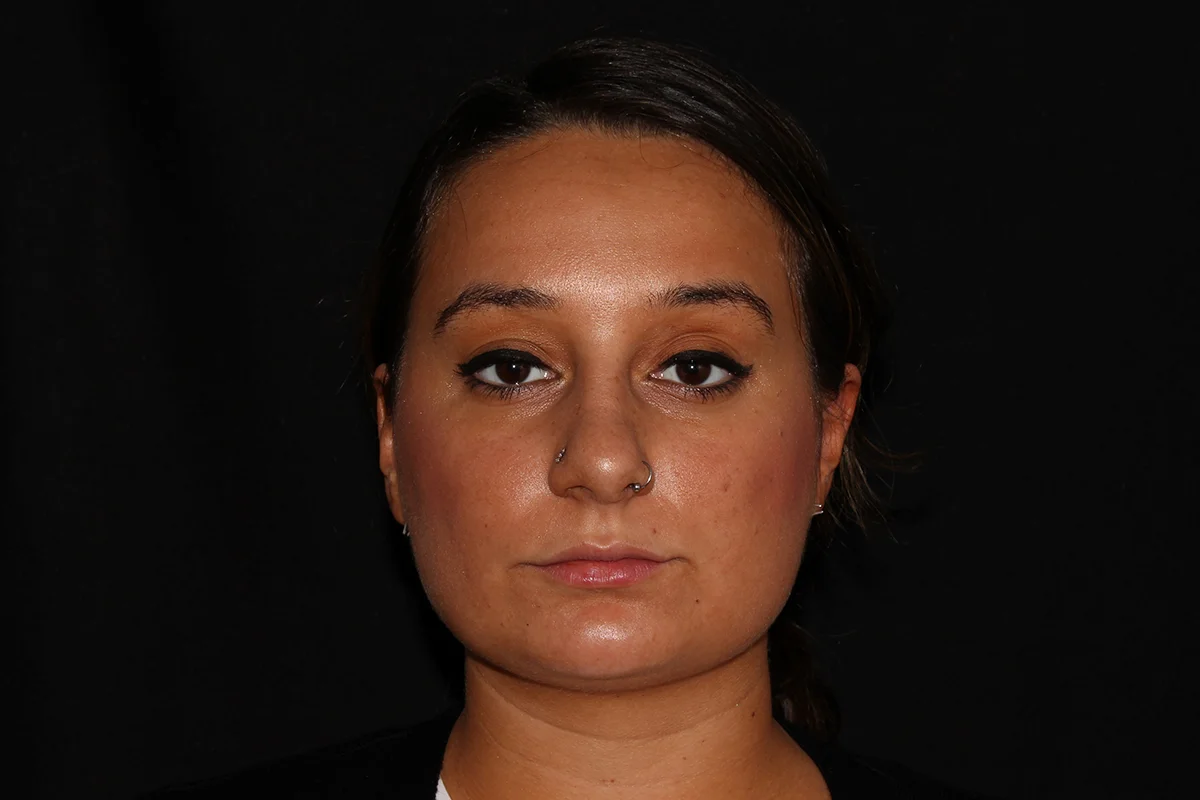 Young woman before lip filler