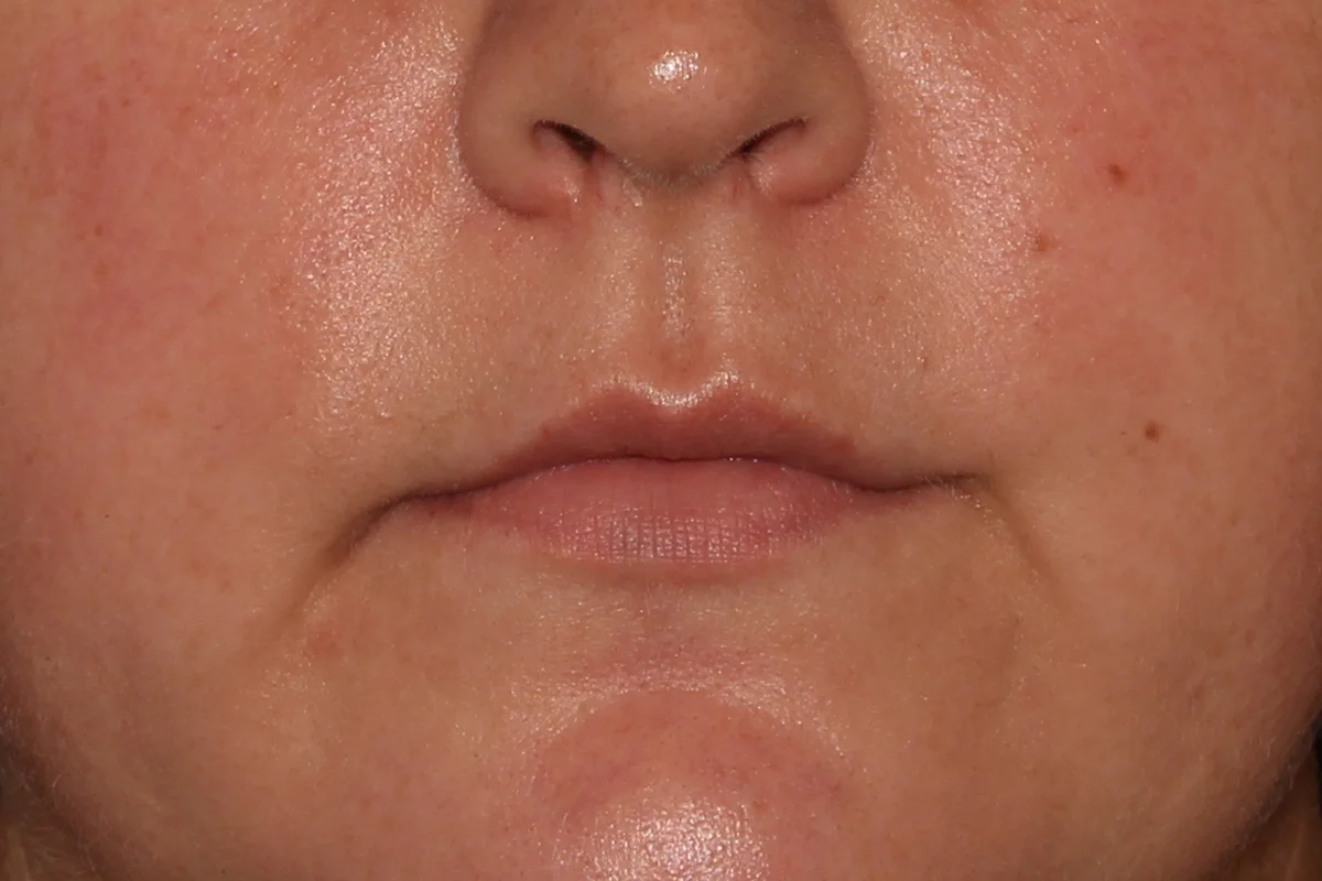 Young woman before lip filler