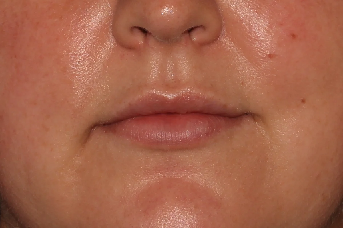 Young woman after lip filler
