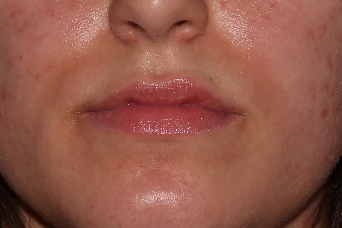 Young woman before lip filler