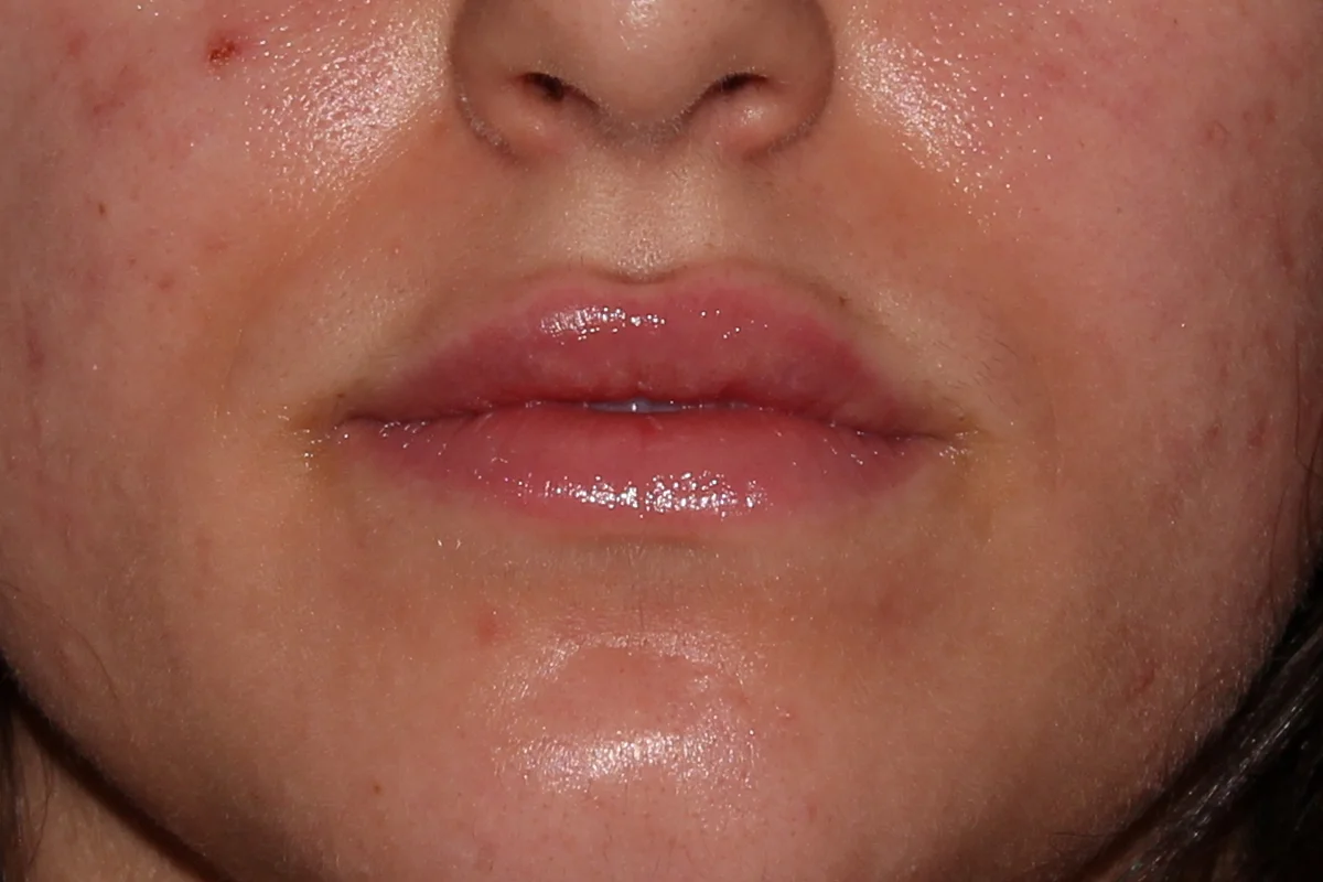 Young woman after lip filler