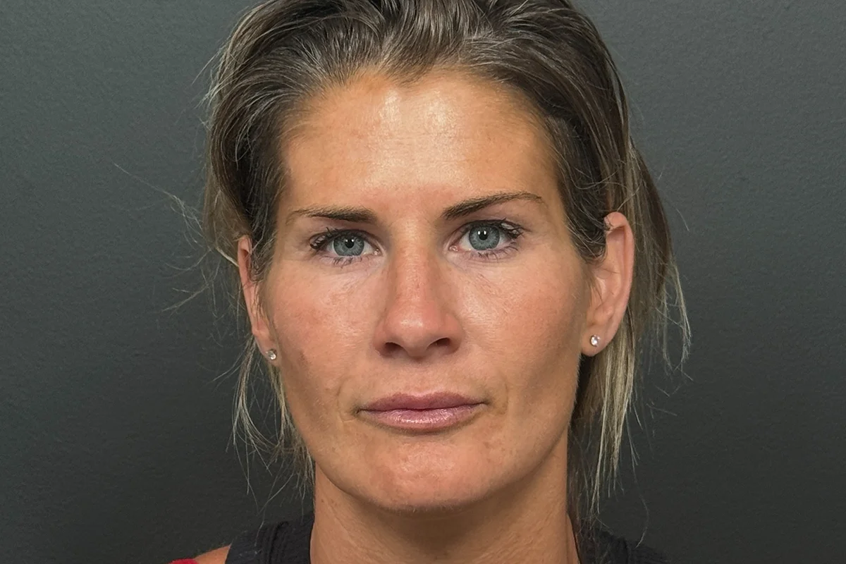 Young woman after lip filler