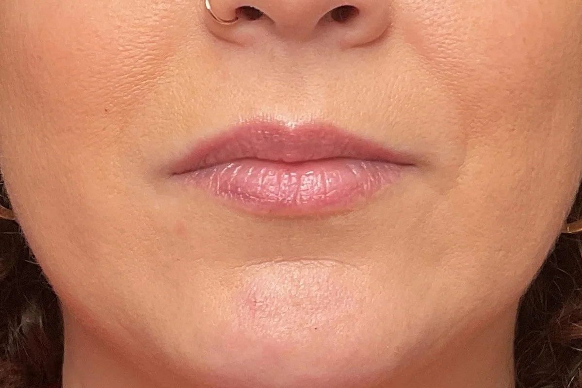 Young woman before lip filler