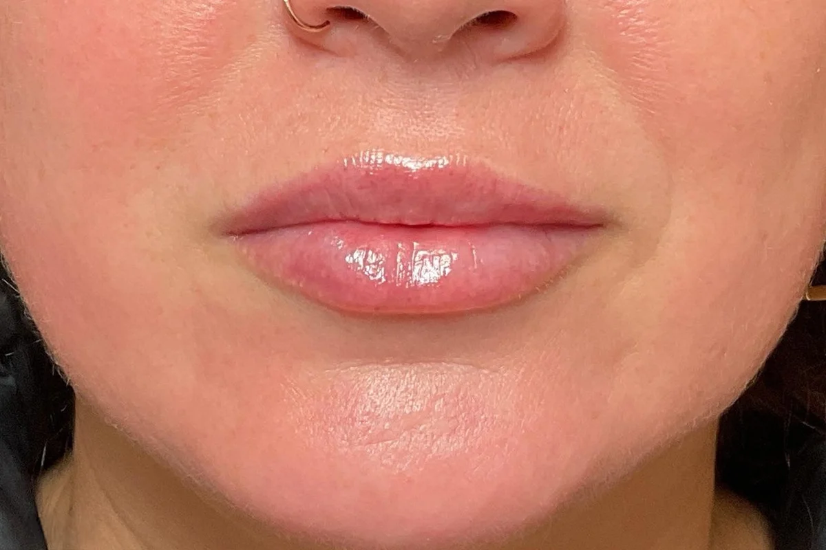 Young woman after lip filler