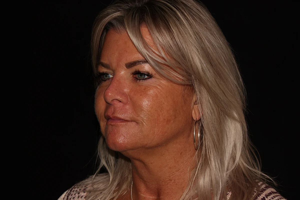 Middle-aged woman before microneedling