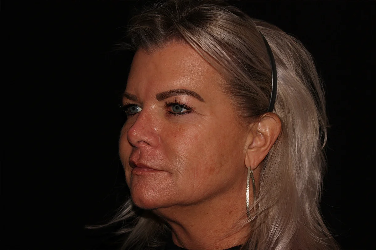 Middle-aged woman after microneedling