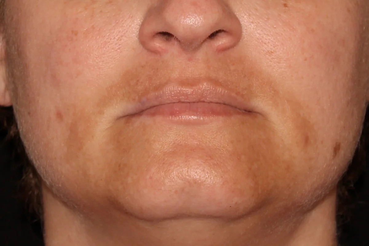 Middle-aged woman before microneedling