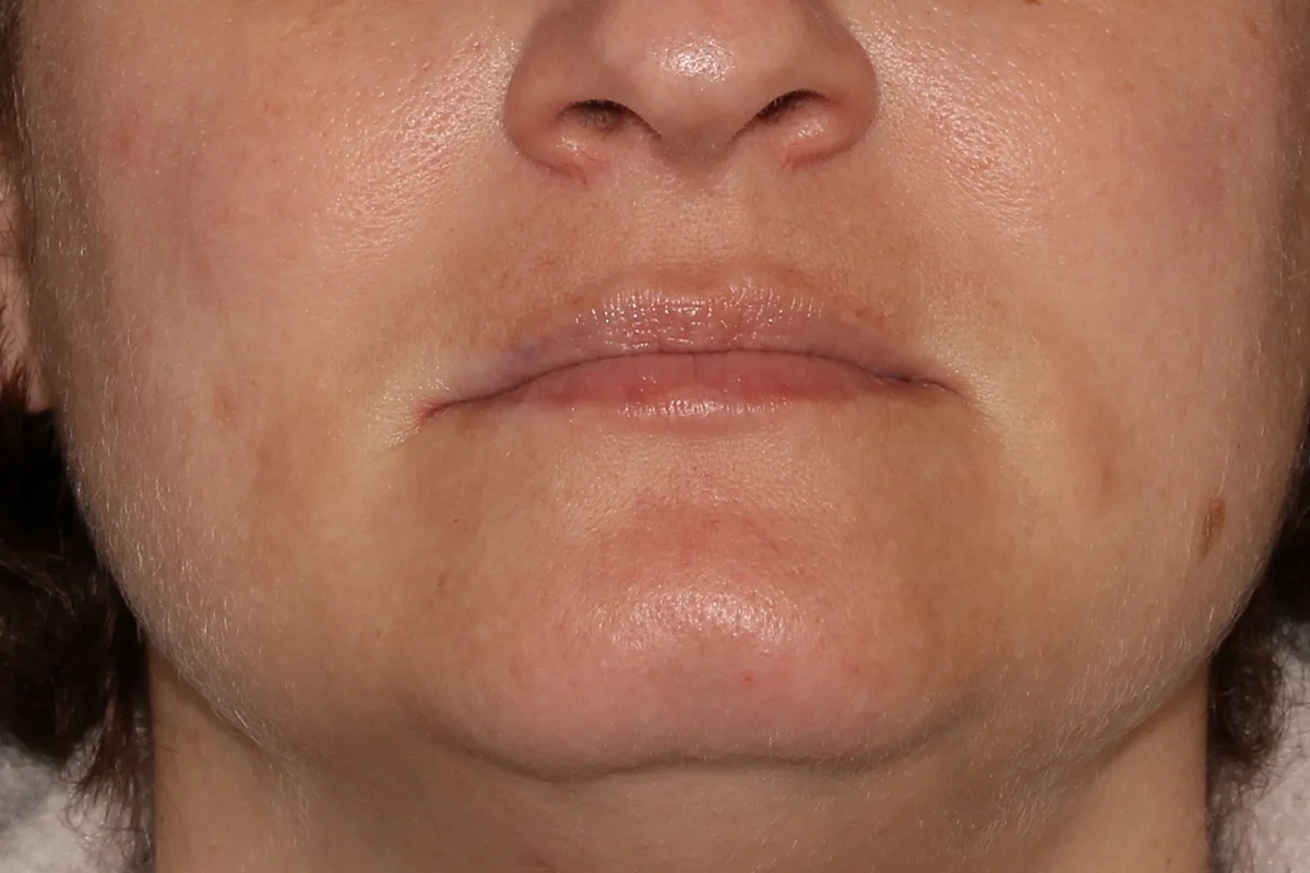Middle-aged after microneedling