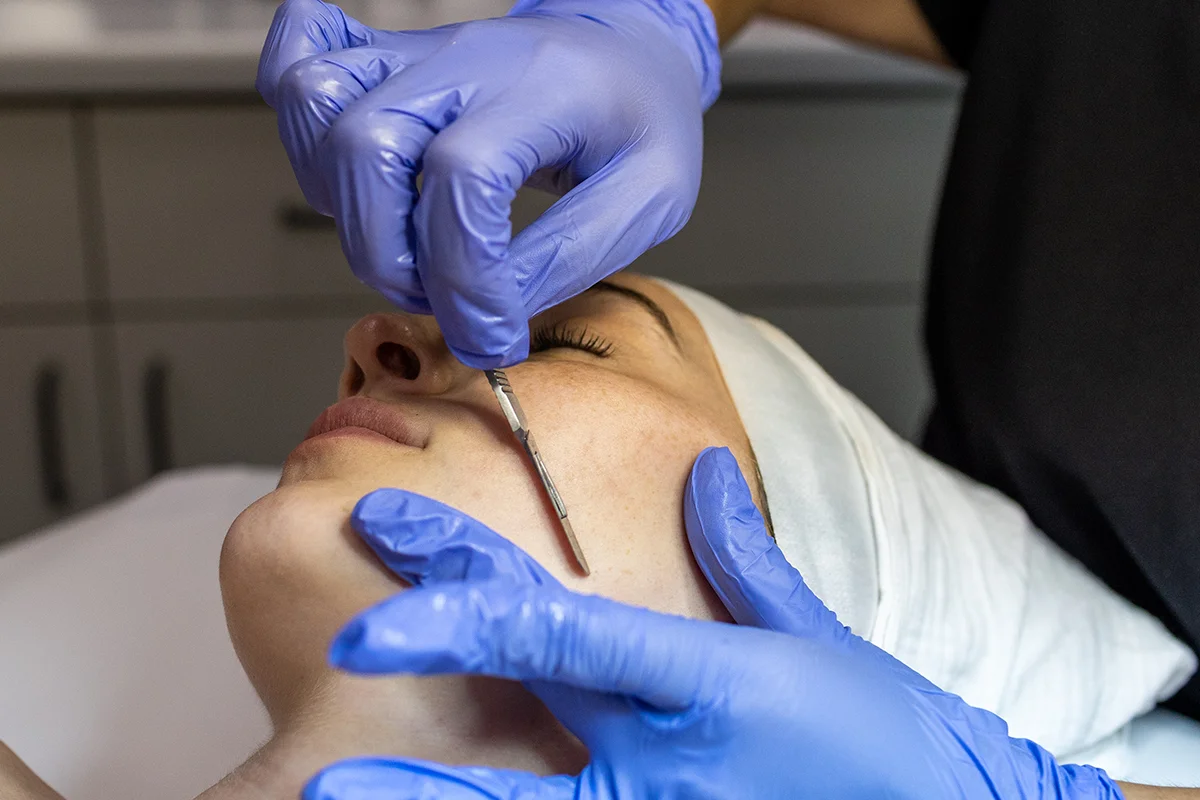Young woman receiving dermaplaning treatment on the side of her face. 