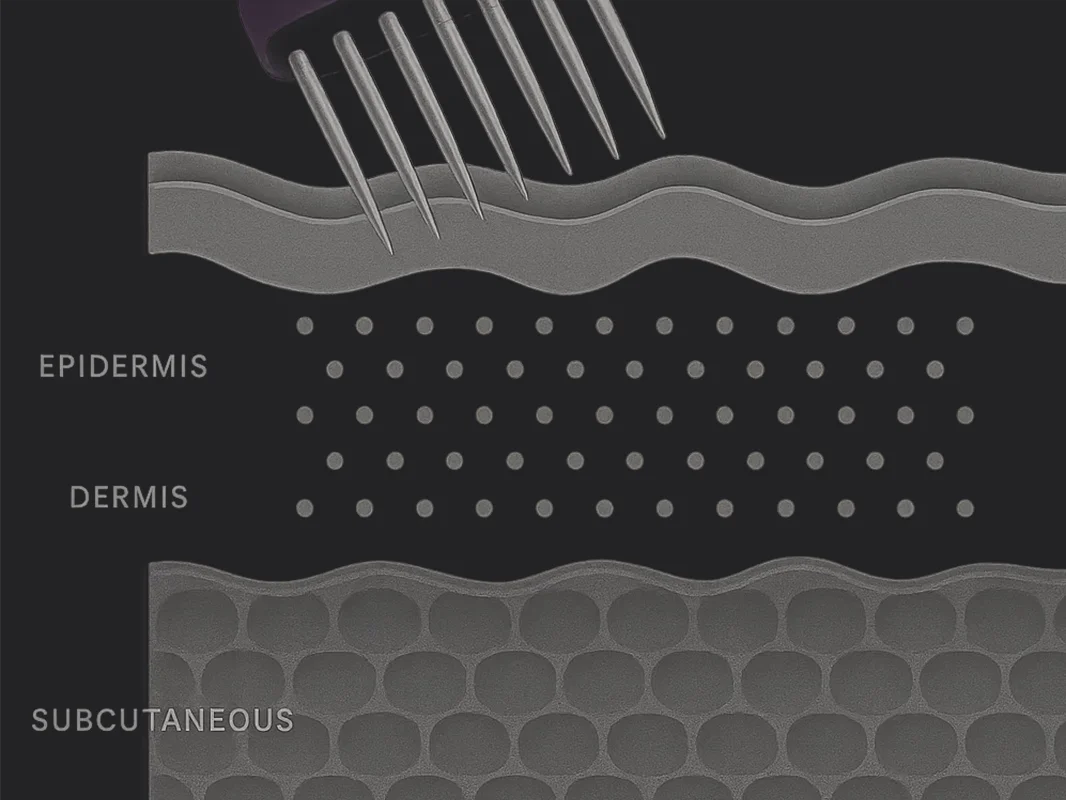 Illustration of a microneedling tool penetrating layers of skin that are labeled in a diagram format.