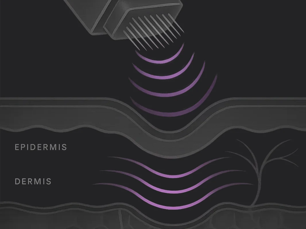 Illustration of an RF microneedling tool penetrating layers of skin that are labeled in a diagram format. 