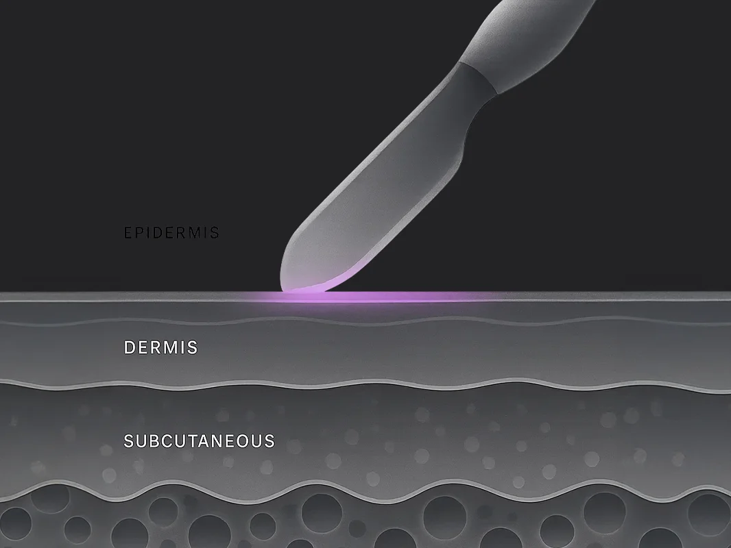 Illustration of a dermaplaning tool being used on the surface layer of the skin (epidermis). 