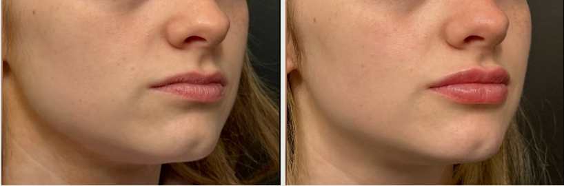 results of lip filler done at the rejuva center in albany
